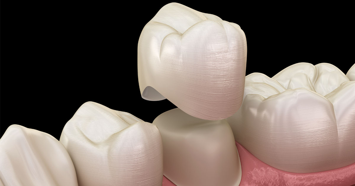 dental crowns pros and cons
