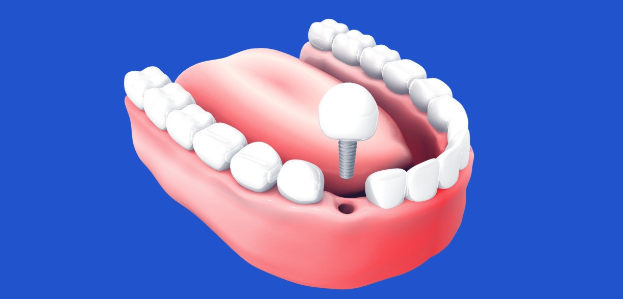 Diabetes and Dental Implants: What You Need to Know