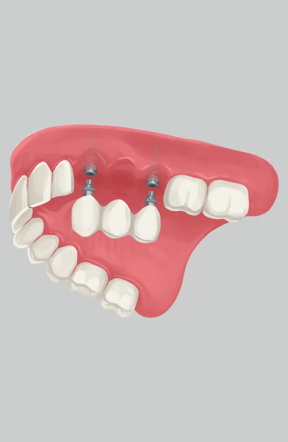 dental implants in brentwood -  hallmark dental brentwood