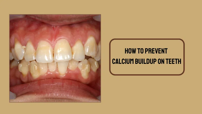 how to prevent calcium buildup on teeth
