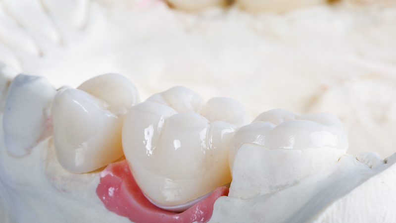 how to remove dental cement from crown